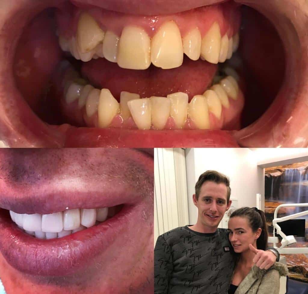 Dental implants before after Turkey 10