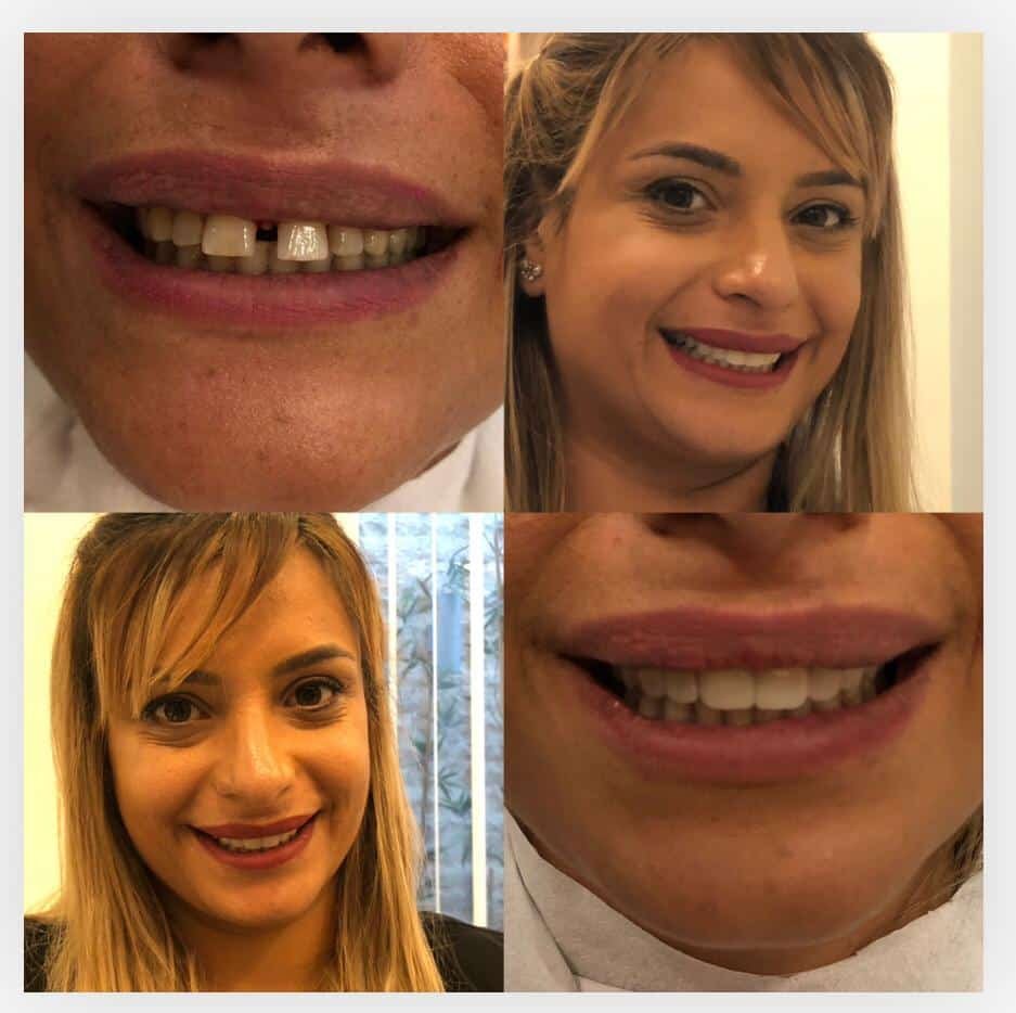 Dental implants before after Turkey 9