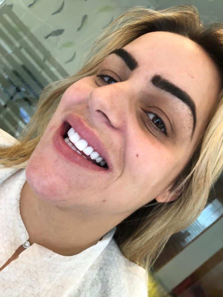 Dental implants before after Turkey 8