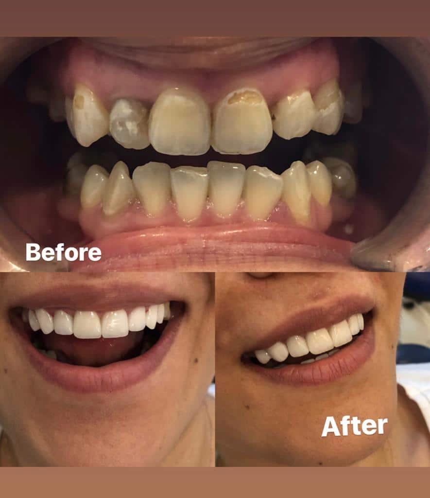 Dental implants before after Turkey 7