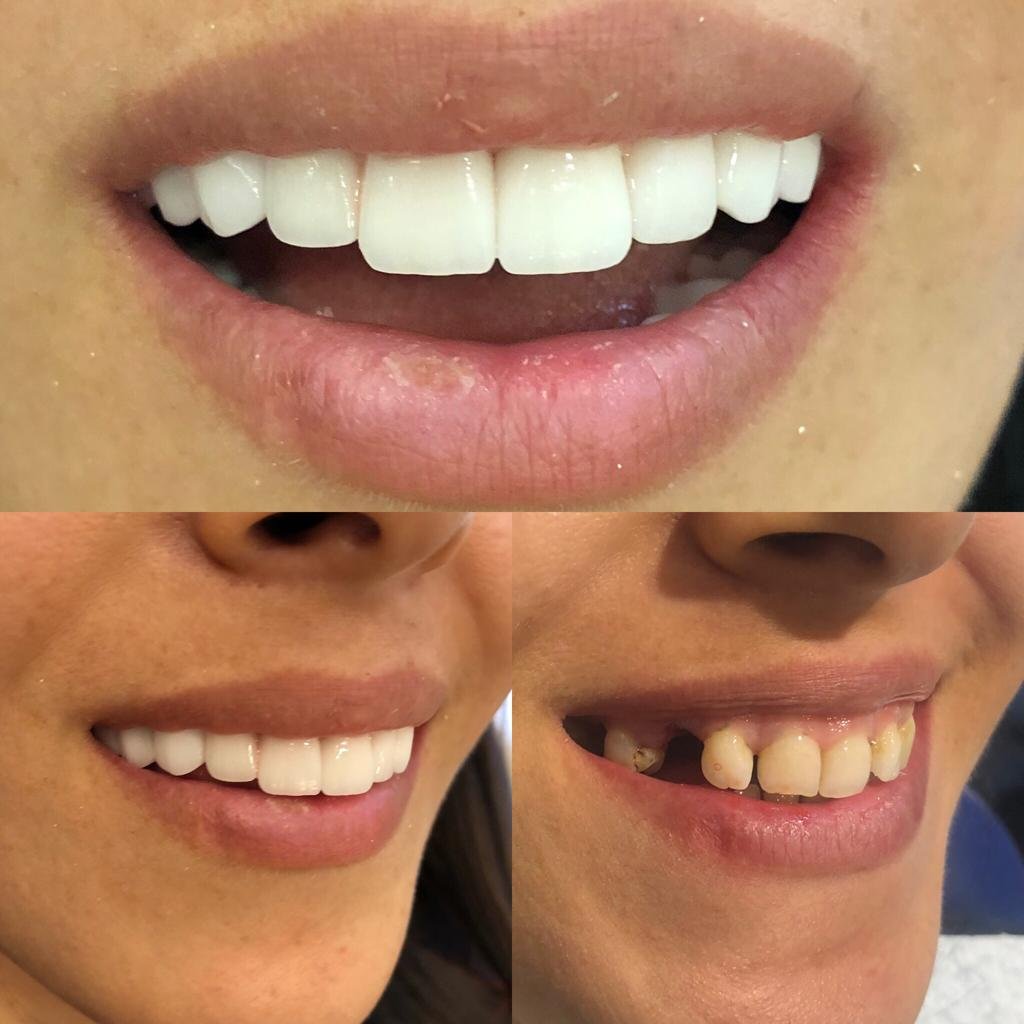 Dental implants before after Turkey 6