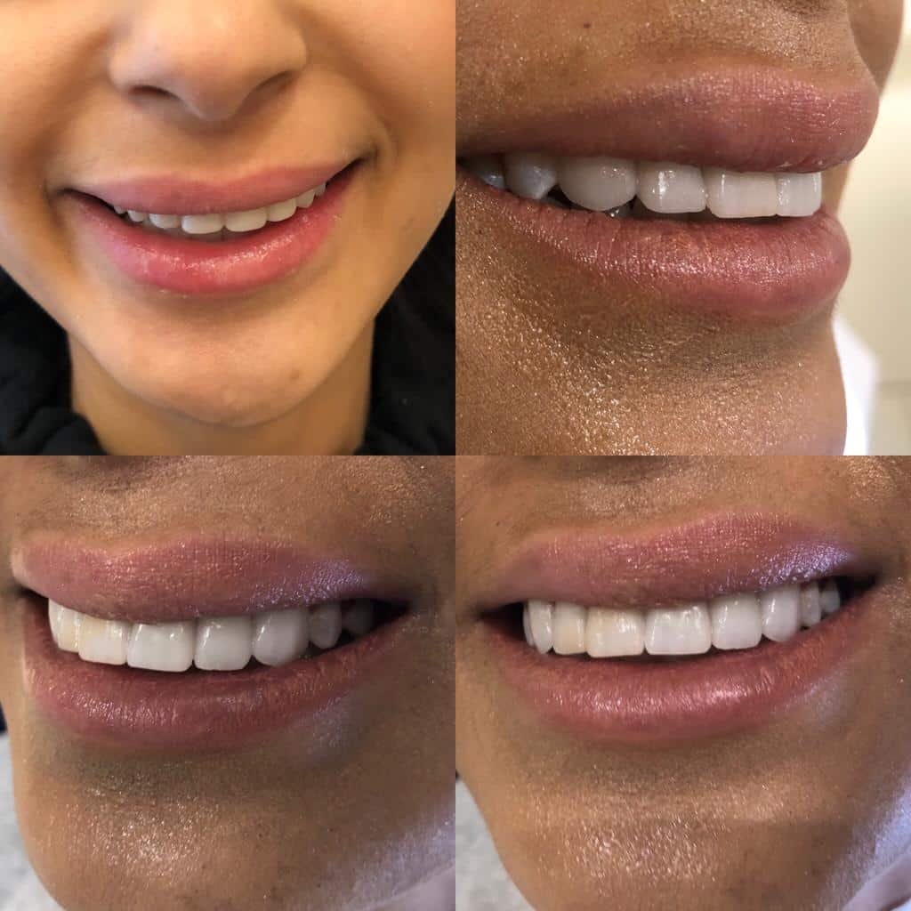 Dental implants before after Turkey 4