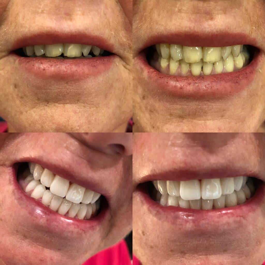 Dental implants before after Turkey 3