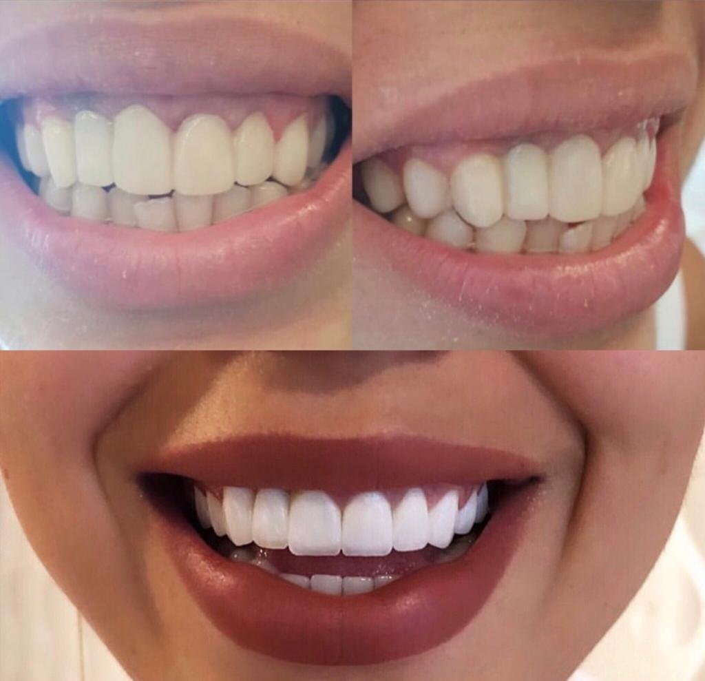 Dental implants before after Turkey 5
