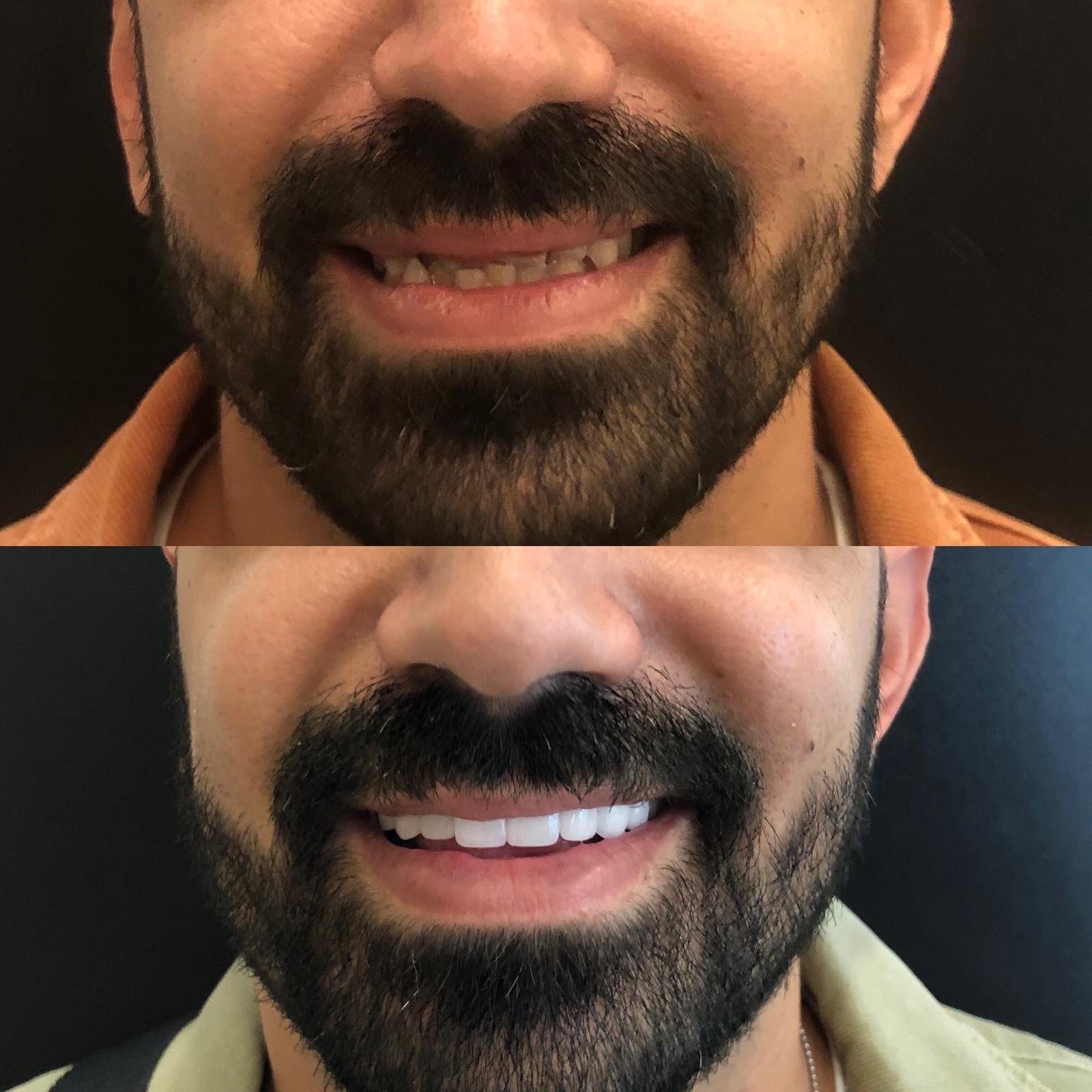 Dental implants before after Turkey 2