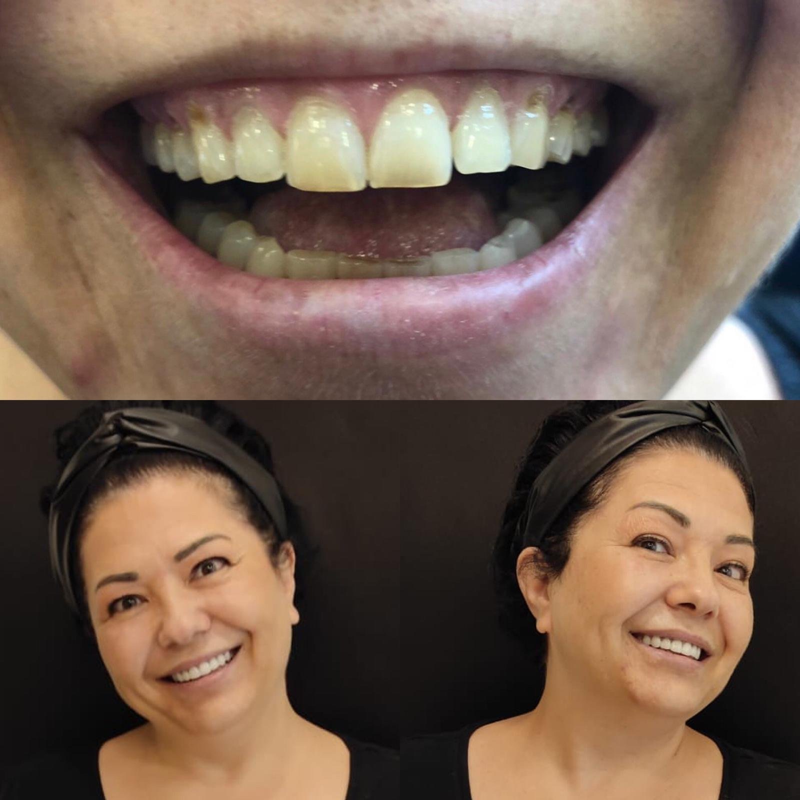 Dental implants before after Turkey 1