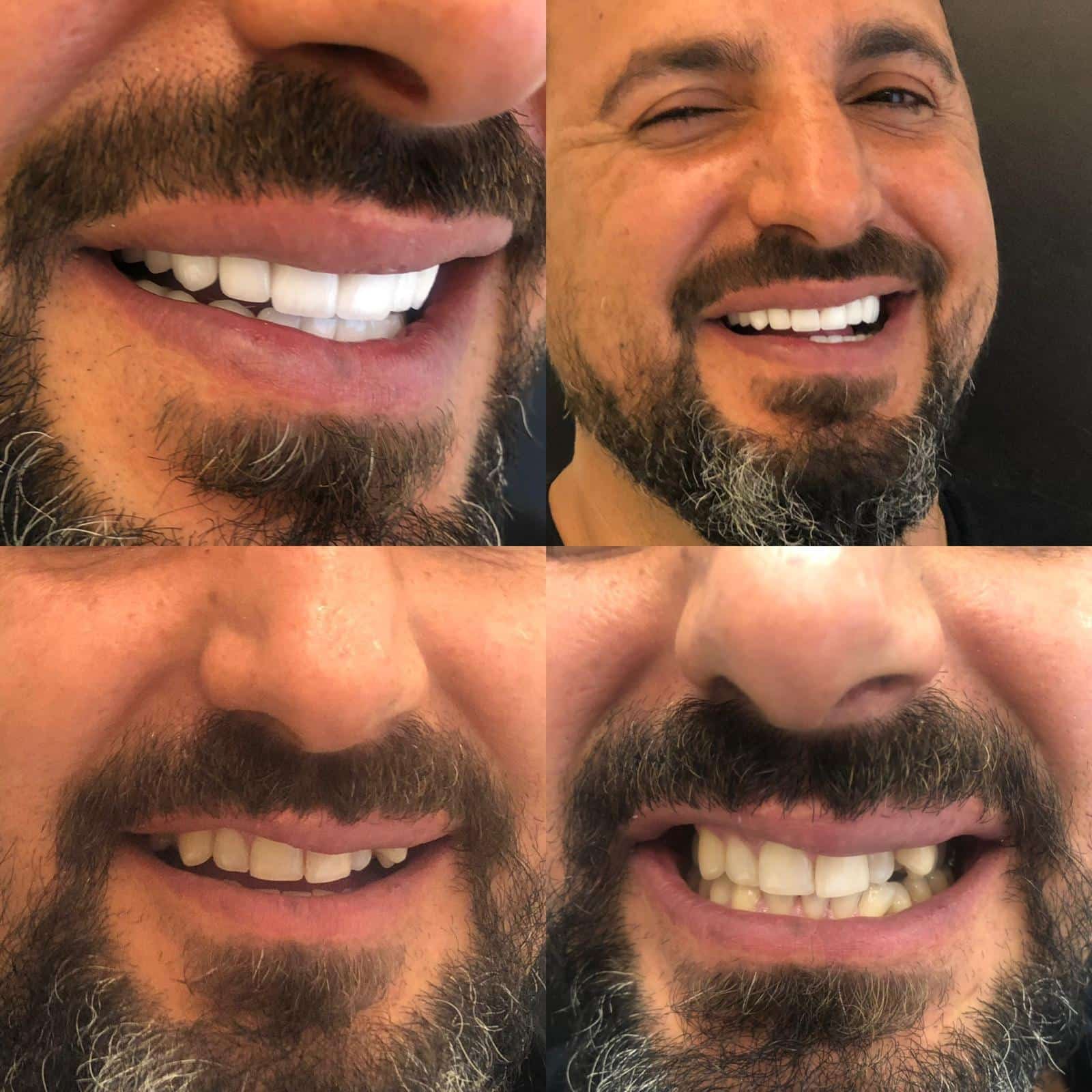 Dental implants before after Turkey 11